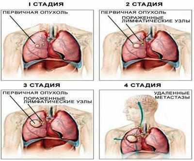Стадии рака легкого