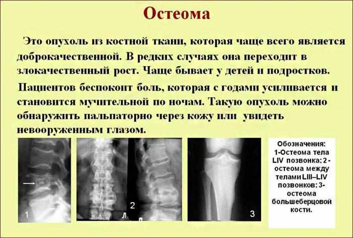 Характеристика остеомы.