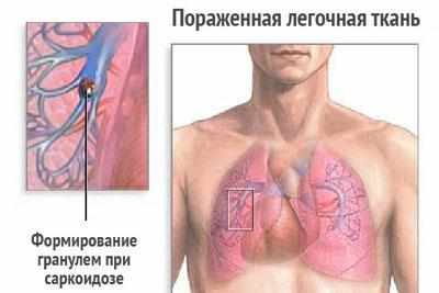Саркоидоз легких
