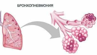 Проявление бронхопневмонии