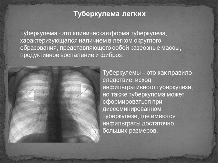 Что такое туберкулема легких