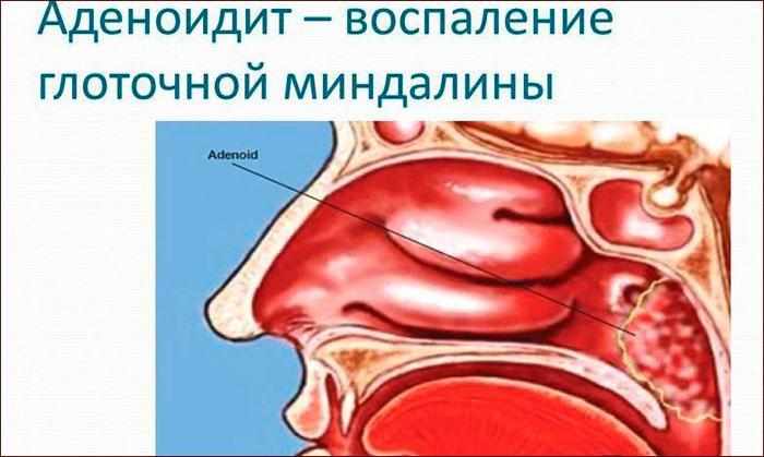 Аденоидит