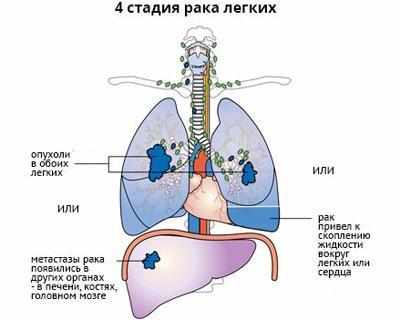 Четвертая стадия рака легкого