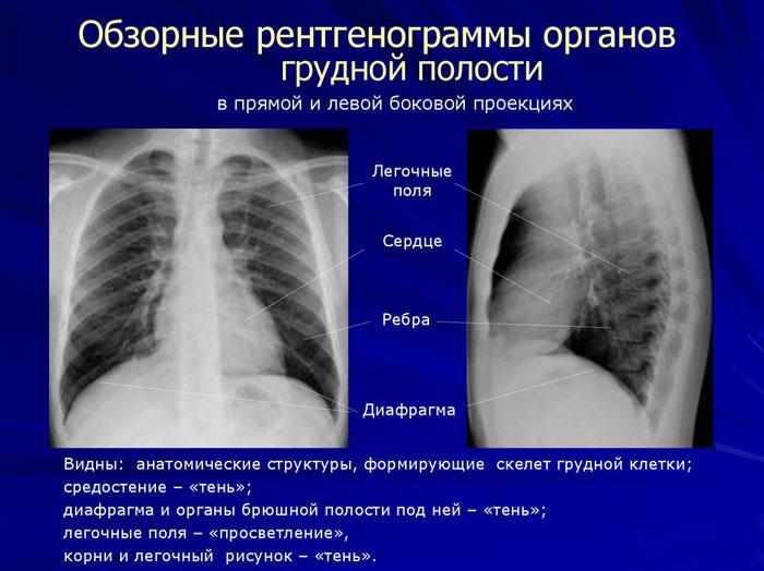 Обзорные рентгенограммы органов грудной полости