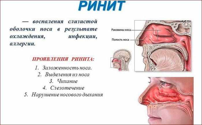 Признаки ринита