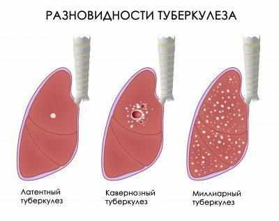 Туберкулёз 