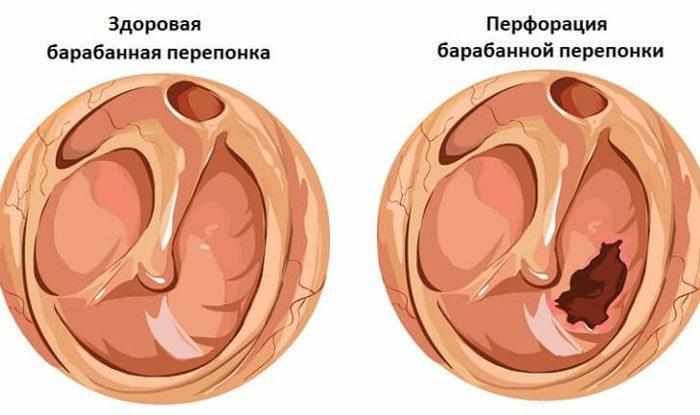 Перфорация барабанной перепонки