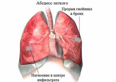 Абсцесс легкого