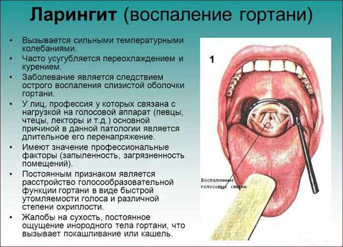Ларингит: симптомы, вызывающие факторы