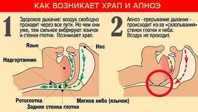 Возникновение храпа