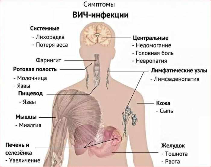 Симптомы ВИЧ