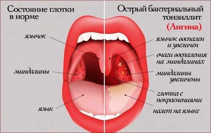 Симптомы ангины