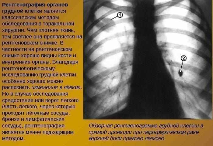 Рентгенография органов грудной клетки