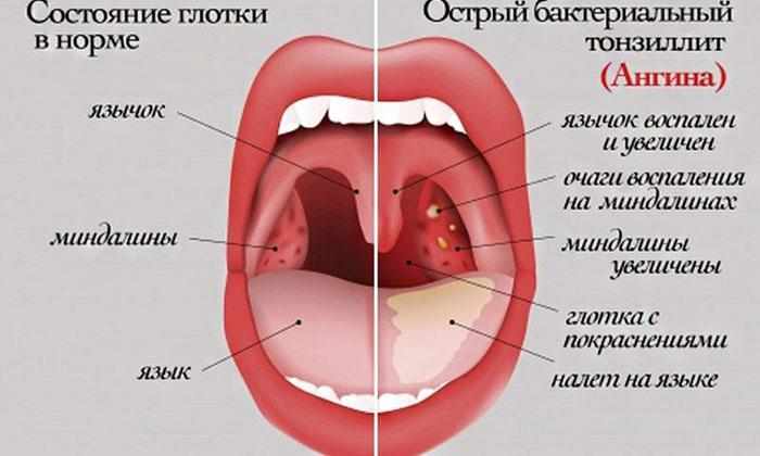 Симптомы ангины
