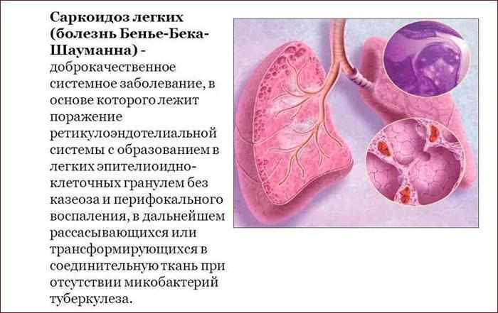 Что такое саркоидоз легких
