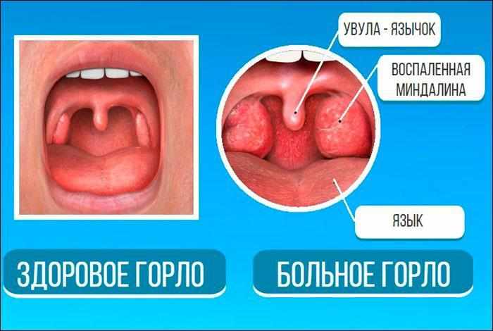 что такое увулит