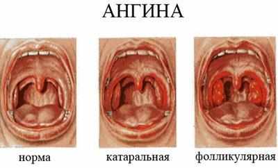 Виды ангины