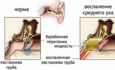 Проявление отомикоза