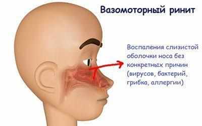 Вазомоторный ринит