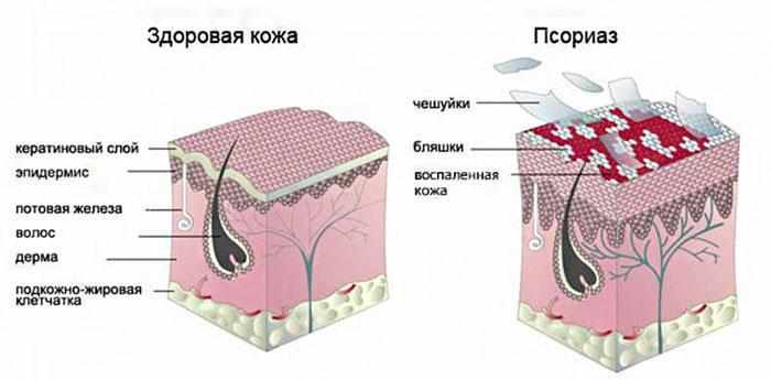 кожа, поражённая псориазом