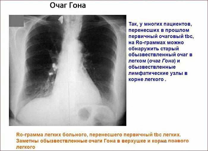 Очаг Гона на рентгене