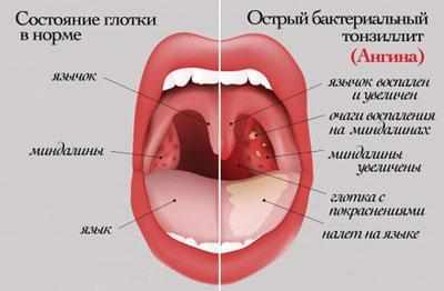 Симптомы ангины
