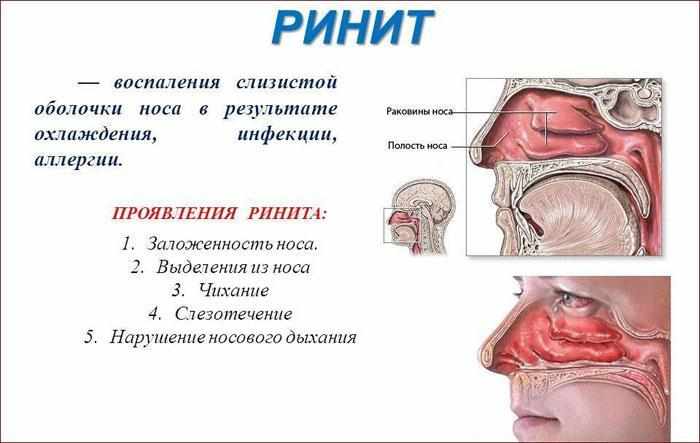 Симптомы ринита