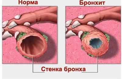 Бронхи при воспалении