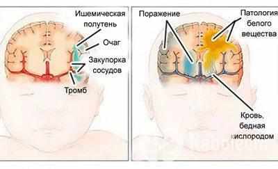 Гипоксия плода