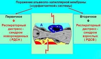 Острый респираторный дистресс-синдром