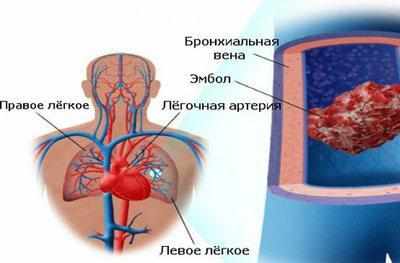 Закупорка легочной артерии
