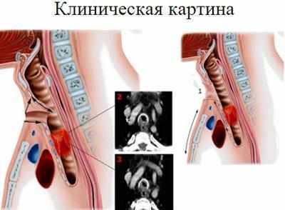 Клиническая картина при стенозе