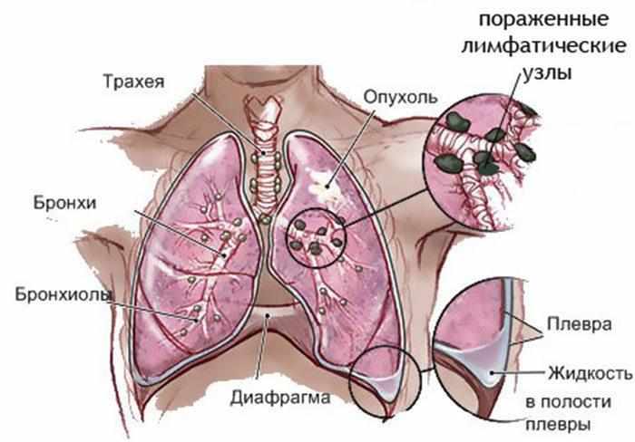 Рак бронхов