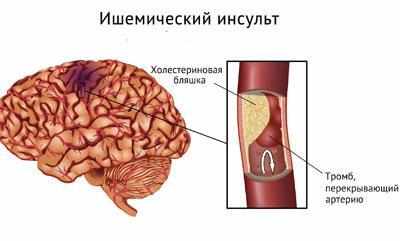 Ишемический инсульт