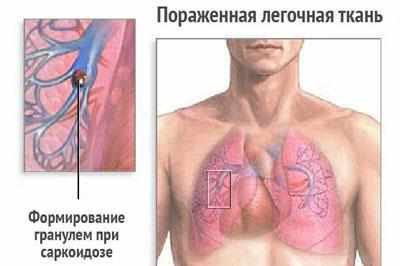 Проявление саркоидоза легких