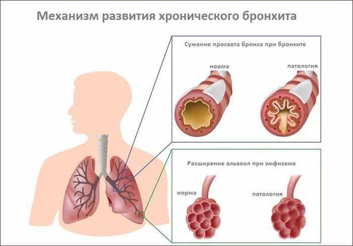 Механизм развития хронического бронхита