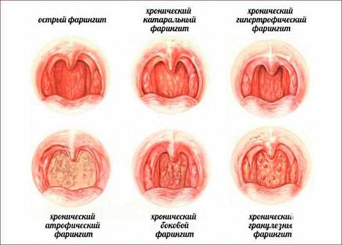Виды фарингита