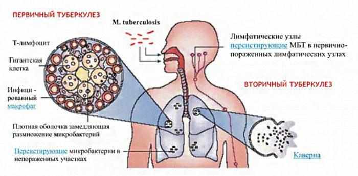 Первичный и вторичный туберкулёз лёгких