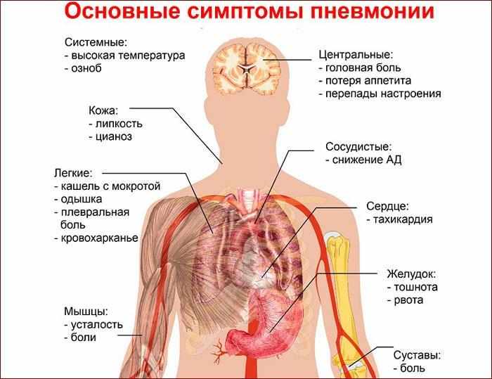 Симптомы при пневмонии