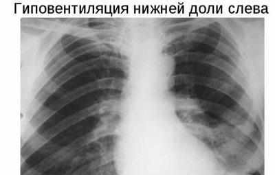 Гиповентиляция легких на рентгене