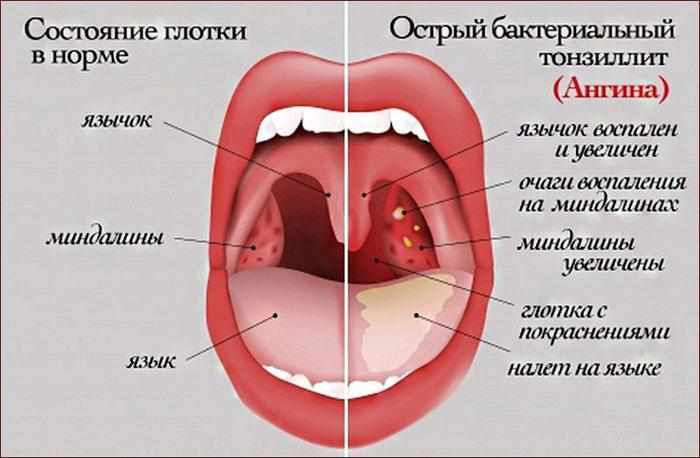 Симптомы ангины