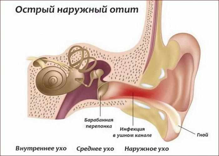 Симптомы наружного отита