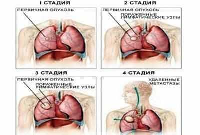 Стадии рака легких