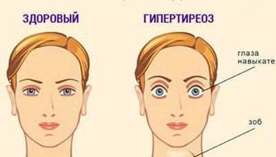 Симптомы гипертиреоза