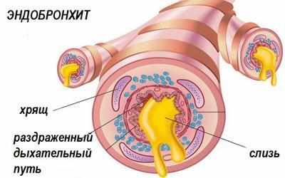 Проявление эндеробронхита