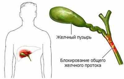 Дискенезия желчного пузыря