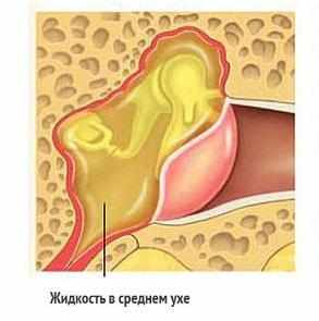 Отит среднего уха