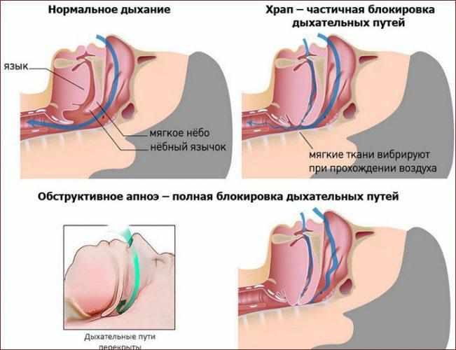 Возникновение храпа