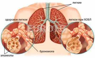Следствие обструктивного бронхита