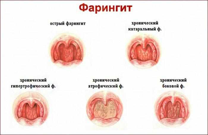 виды и симптомы фарингита